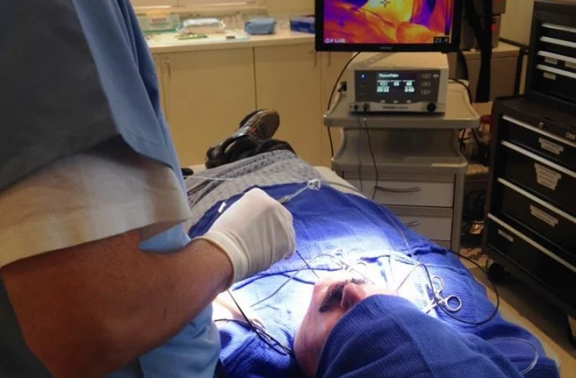 ThermTight facelift Santa Rosa