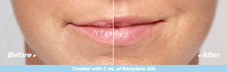 before and after restylane silk
