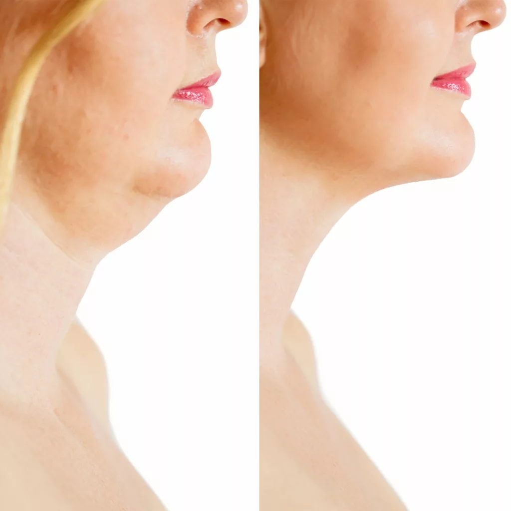 before and after kybella injections to eliminate double chin