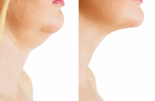 before and after kybella injections to eliminate double chin
