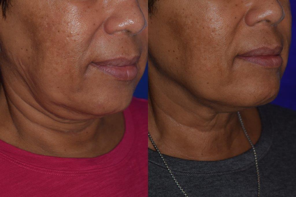 before and after kybella injections