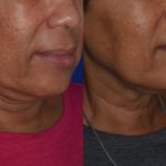 before and after woman's kybella injections to address double chin fat