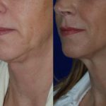 before and after woman's kybella injections to address double chin fat