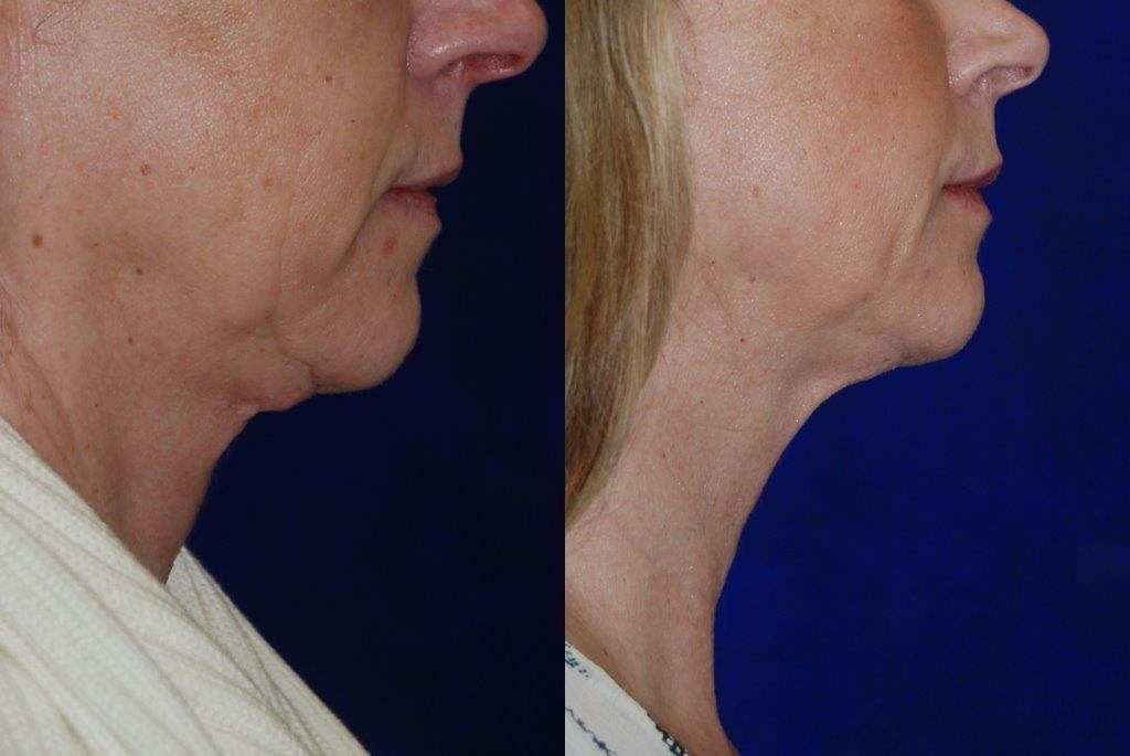 before and after kybella injections