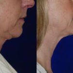 before and after woman's kybella injections to address double chin fat