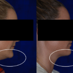 before and after woman's kybella injections to address double chin fat