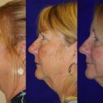 before and after woman's kybella injections to address double chin fat