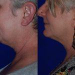 before and after woman's kybella injections to address double chin fat