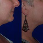 before and after woman's kybella injections to address double chin fat