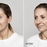 restylane lyft before and after