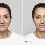 restylane lyft before and after