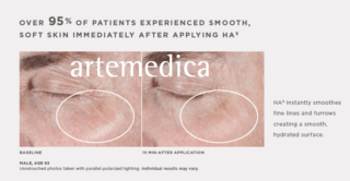SkinMedica skincare Ha5 before and after eye wrinkles