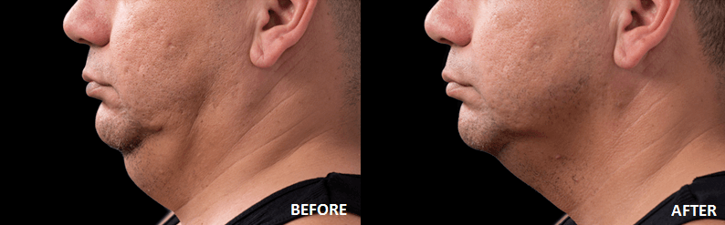 before and after coolsculpting coolmini to address double chin