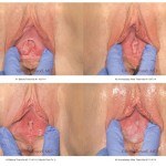 ThermiVa Vaginal Rejuvination