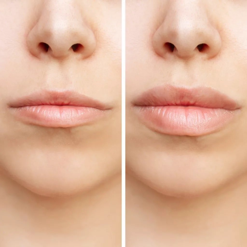 before and after juvederm volbella injectable fillers for plumper lips