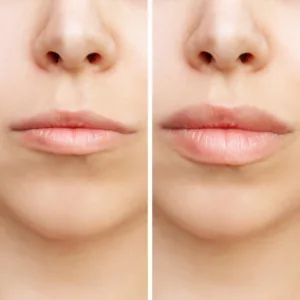 c'est la vie lip filler Juvéderm Volbella XC - Lip Filler