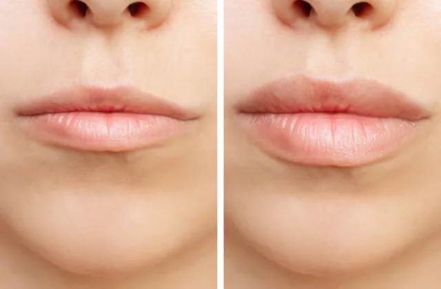 before and after juvederm volbella injectable fillers for plumper lips