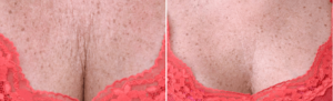 sculptra before and after