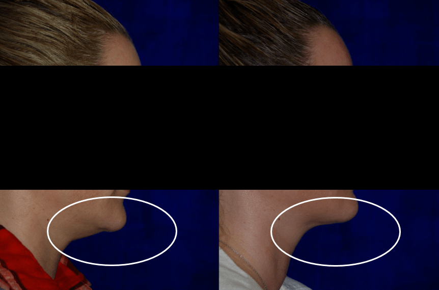 kybella before and after