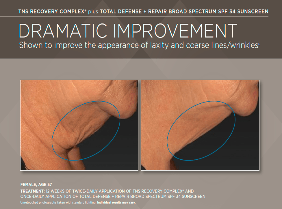 before and after skinmedica tns recovery complex