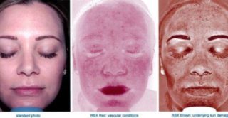 Skin Analysis of facial Complexion