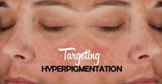 hyperpigmentation facial treatment available at artemedica in sonoma county