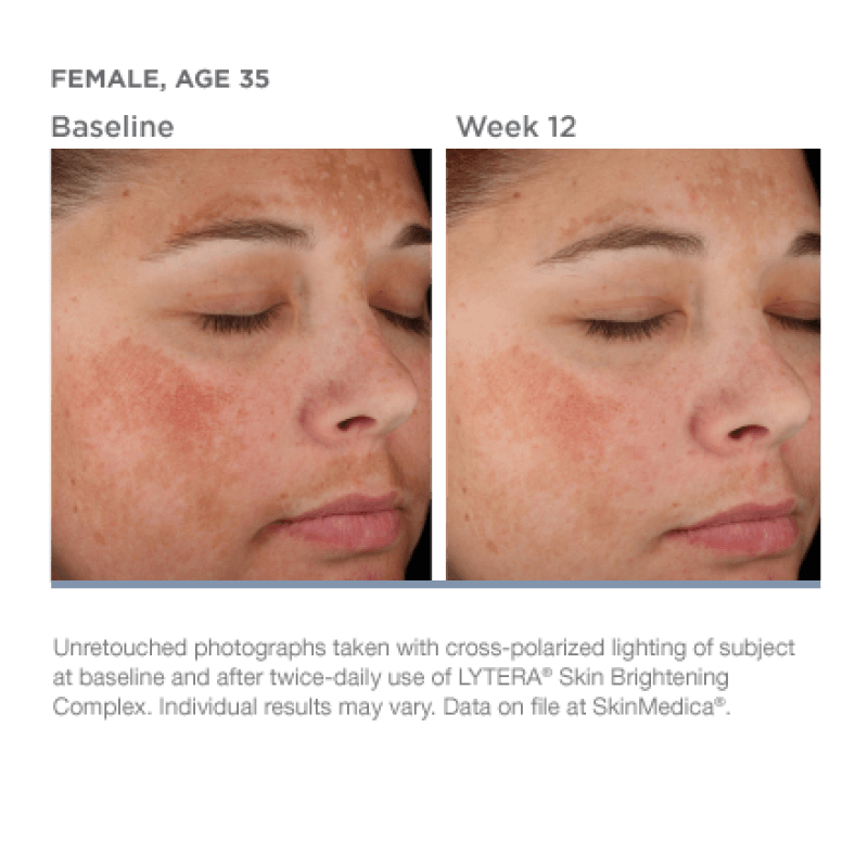 before and after hyper pigmentation laser treatment at artemedica