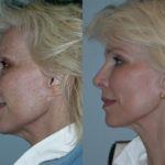 Before and after woman's laser pigmentation facial treatment