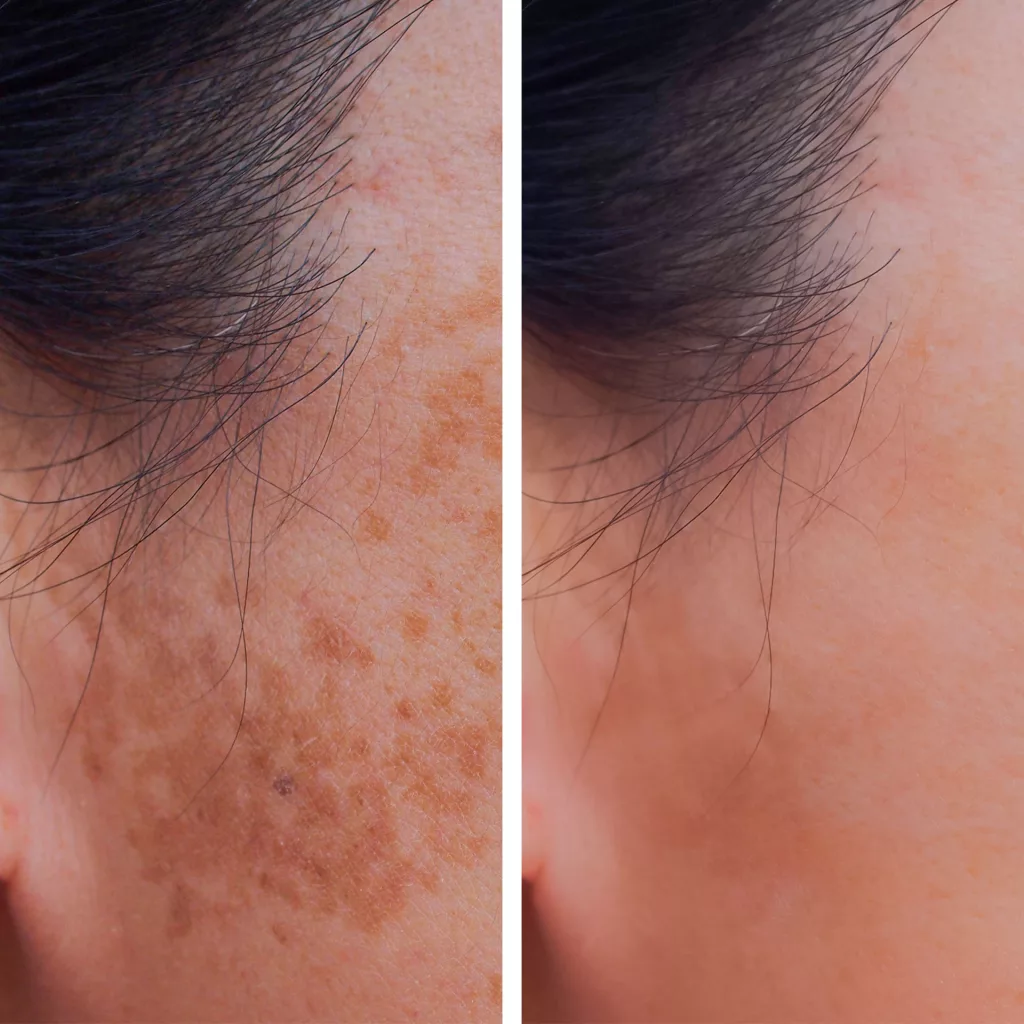 before and after laser pigment correction treatment