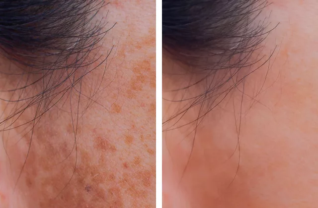 before and after laser pigment correction treatment