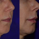 Before and after woman's injection of Juvederm volbella to enhance lips