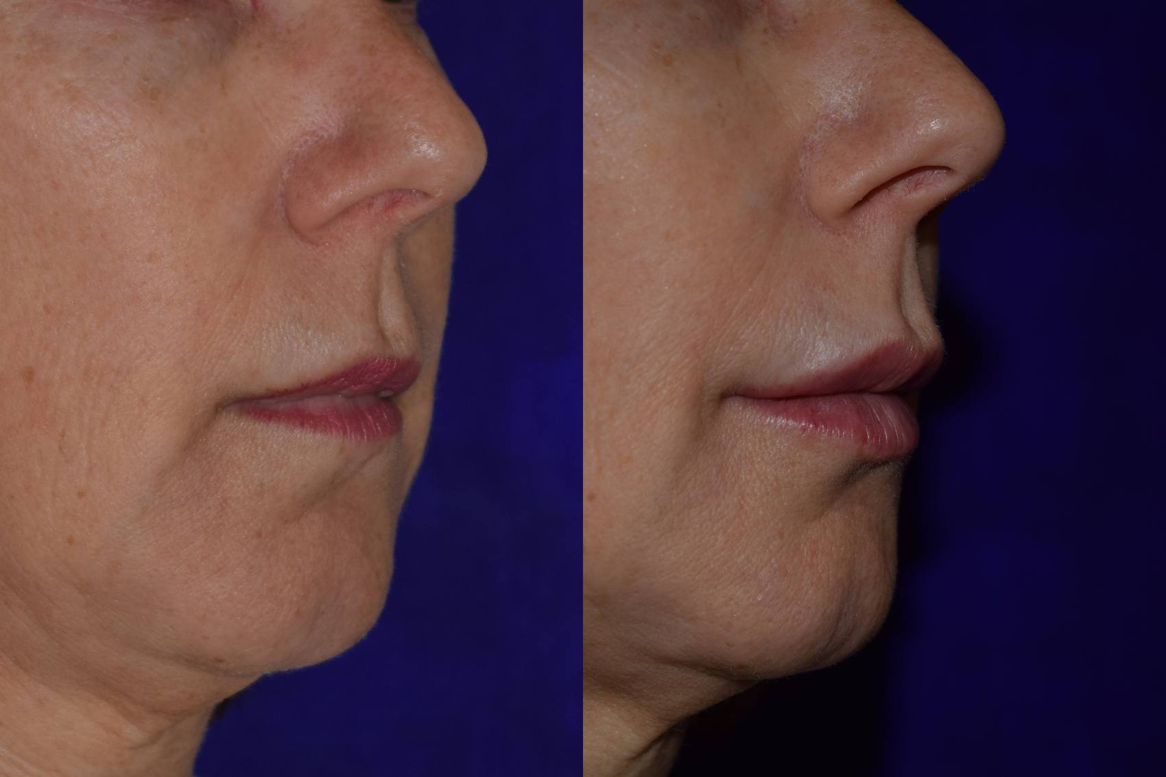 before and after juvederm volbella lip fillers