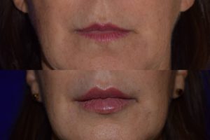 before and after juvederm lip fillers
