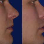 Before and after woman's injection of Juvederm volbella to enhance lips