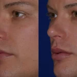 Before and after woman's injection of Juvederm volbella to enhance lips