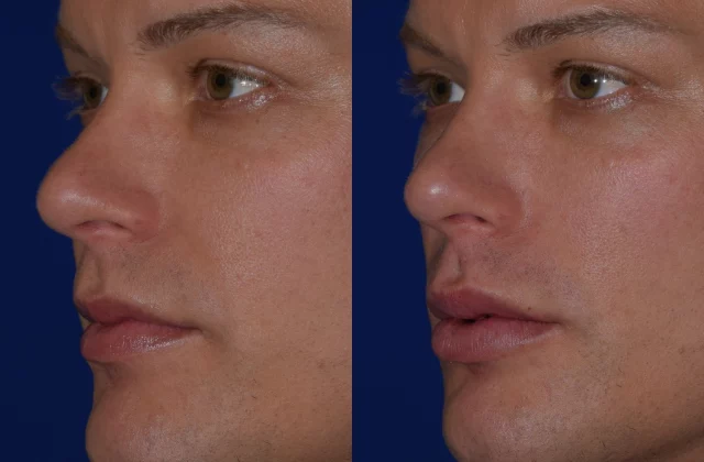 Before and after woman's injection of Juvederm volbella to enhance lips