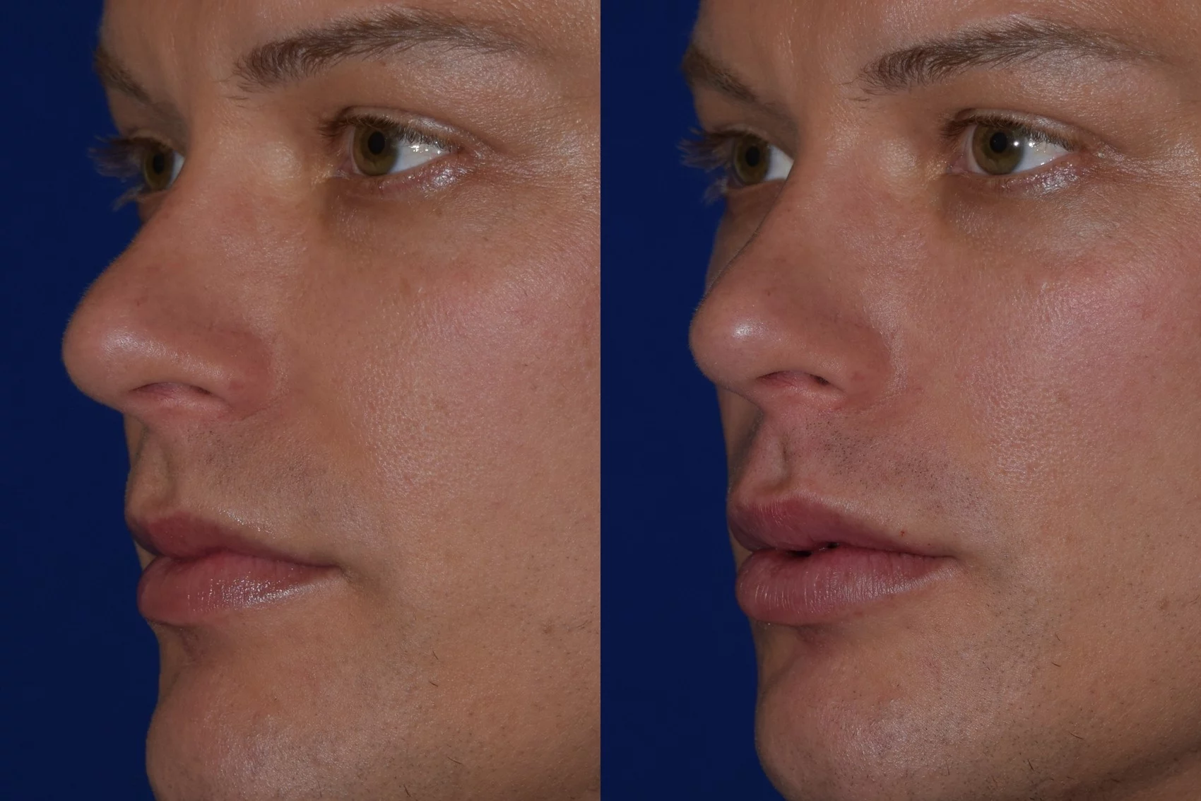 before and after juvederm volbella lip fillers