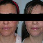 Before and after woman's laser pigmentation facial treatment