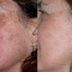 Before and after woman's laser pigmentation facial treatment