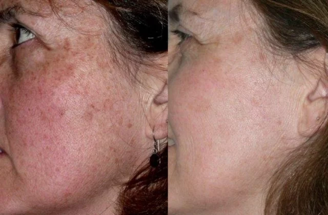 Before and after woman's laser pigmentation facial treatment