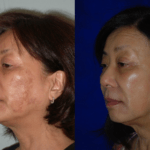 Before and after woman's laser pigmentation facial treatment