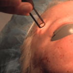 Esthetician using laser facial treatment on client's forehead