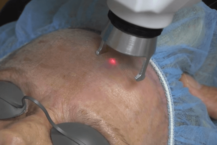 fractional laser resurfacing treatment