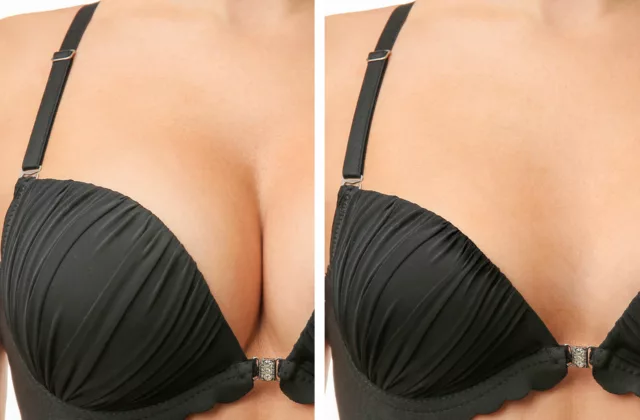 before and after breast implant removal surgery
