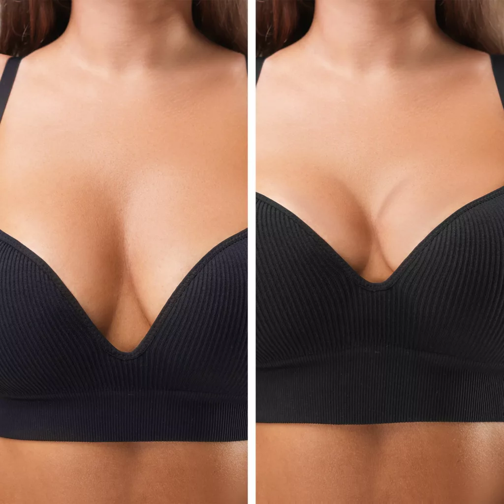 before and after breast lift surgery