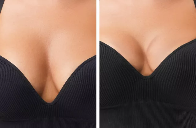 before and after breast lift surgery