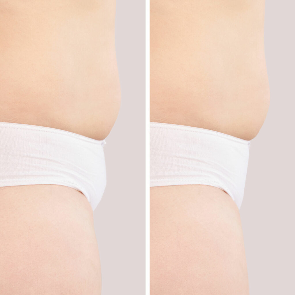 before and after monsplasty to eliminate FUPA