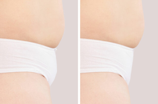 before and after monsplasty to eliminate FUPA