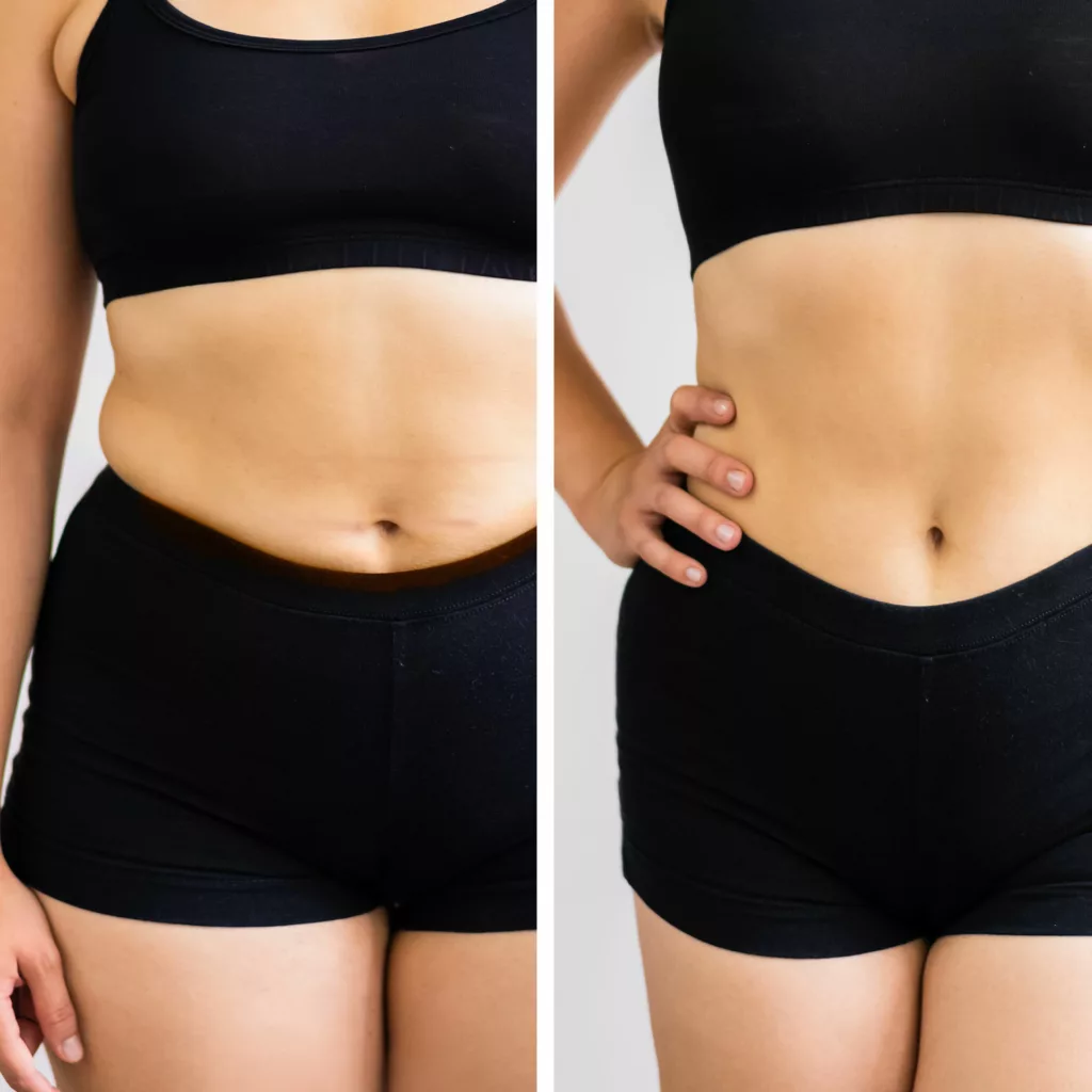 before and after a tummy tuck to address excess skin and fat as well as separated muscles