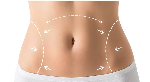 woman's abdomen with arrows illustrating body lift procedure